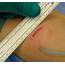 Surgical Incision With The Blu Stent In Place  Download Scientific
