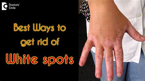 How To Treat White Spots On The Skin Dr Rasya Dixit Youtube