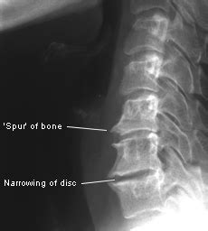Cervical spondylosis symptoms can vary from person to person and the extent of cervical spine pain depends on the age of the affected person. Spondylosis, Spondylolysis and Spondylolisthesis