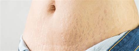 Vancouver Stretch Mark Treatments Surrey Lasers Langley White