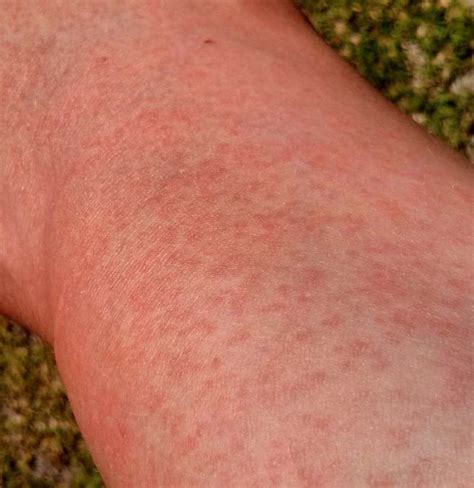 How to get rid of a rash: Maculopapular rash: Causes, treatment, and pictures
