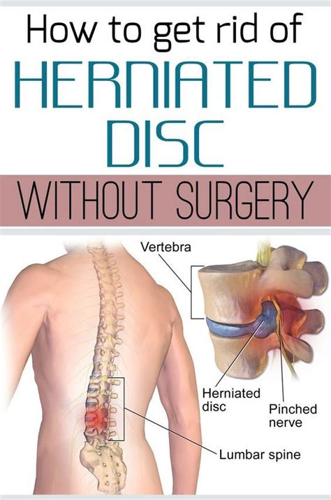What are the symptoms of a bulging disc l4/l5? How to get rid of herniated disc without surgery ...