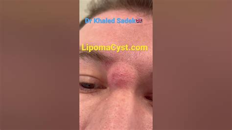 Massive Face Cyst Removal Dr Khaled Sadek Acne Blackheadremoval