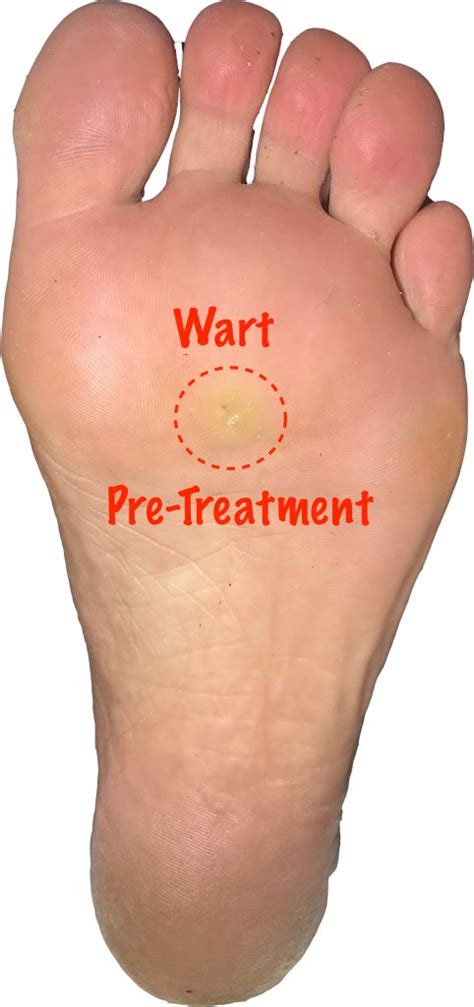 Podiatrist Treatment For Foot Warts Or Plantar Verrucae