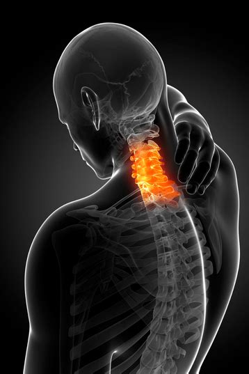 Cervical Radiculopathy Surgery All You Need To Know