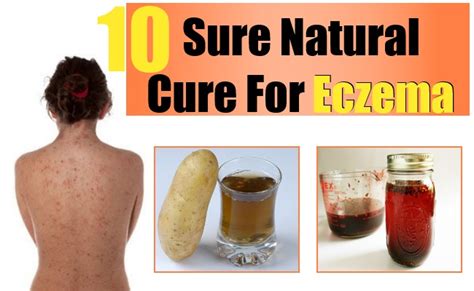 Sure Natural Cure For Eczema How To Cure Eczema Naturally Natural