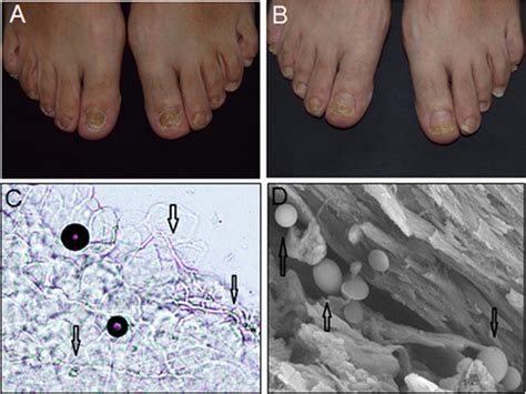 Scanning Electron Microscopy Of The Nail Plate In Onychomycosis
