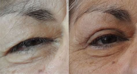 Bags Under Eyes Mayo Clinic Natural Wrinkle Removal Techniques And