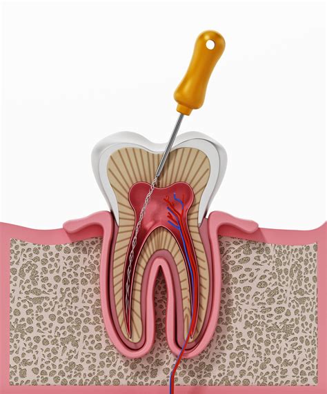 Conoce los tipos diferentes tipos de endodoncia Clínica Dental en