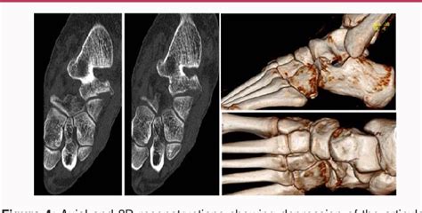 Figure 1 From Isolated “nutcracker” Fracture Of The Anterior Calcaneal
