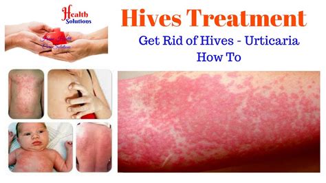 Hives Treatment Get Rid Of Hives Urticaria How To Youtube