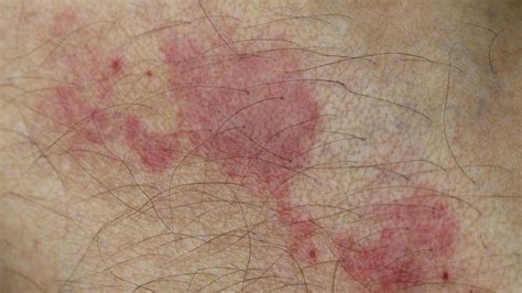 La Dermatite Atopique Ou Eczéma Le Cercle Infernal Récidives Rémissions