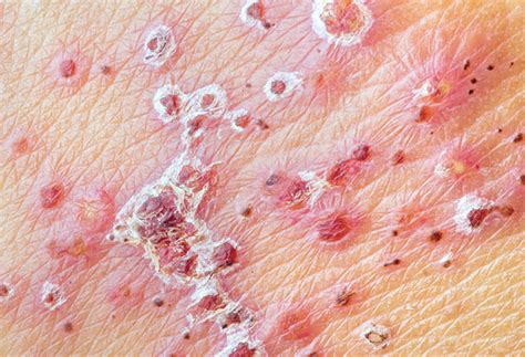 I got tired of not really understanding why hsv was performing better for me over rgb… during a previous post i transitioned from using an rgb detection method to a hsv one. Cold Sores Online Treatment | Herpes Simplex 1 Treatment ...