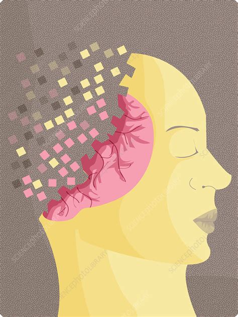 Illustration Of Alzheimers Disease Stock Image F0194901 Science