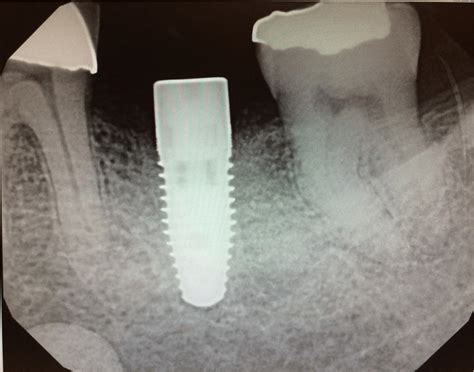 Implant Procedure By Dr Chaulong Los Altos Dental Excellence