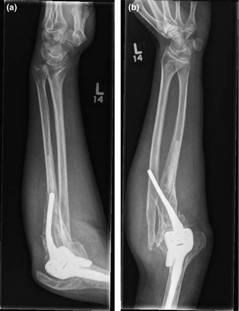 X Ray Of Left Forearm A Lateral And B Ap Views Of Left