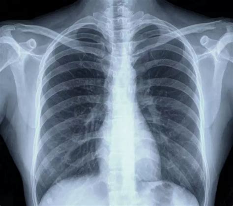 Lung Cancer X Ray Photos — Examples Of Different Types Of Results