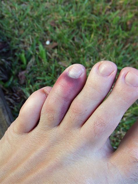 Bruised Toes Result Of Julies Housewarming Party Julie Flickr