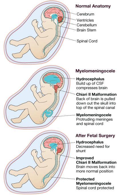 122 best spina bifida images on pinterest occupational therapist occupational therapy and