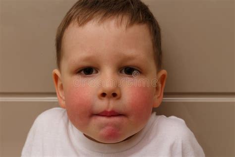 The Boy Has Red Cheeks A Rash On His Cheeks In The Child A Rash On