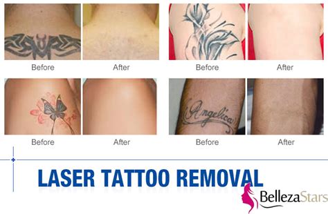 Yag laser tattoo removal machine model: 1064nm 1320nm & 532nm Tattoo Removal Nd Yag Laser - Beauty ...