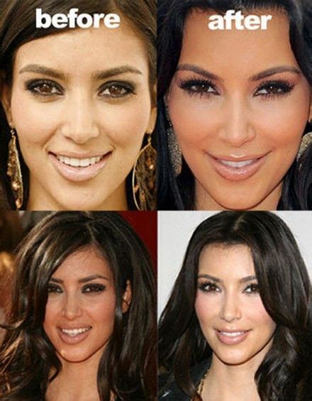 Kim Kardashian Before And After Plastic Surgery Facebookhayranpazar
