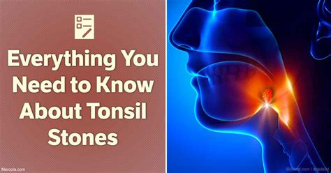 How Do You Know If You Have Tonsil Stones Hpdesign Am