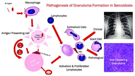 Pathogenesis Of Granuloma Formation In Sarcoidosis Download
