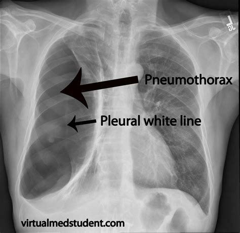 Pneumothorax Clumsy Lost Medical Student That Cant Find The Bandages