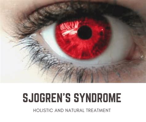 Natural Treatments For Sjogrens Syndrome Part 1