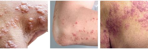 Shingles Disease Causes Symptoms And Treatments Premier Clinic