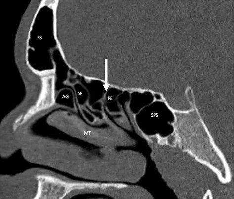 Ethmoid Sinus Anatomy In A Year Old Girl Sagittal Ct Image In Bone Download Scientific