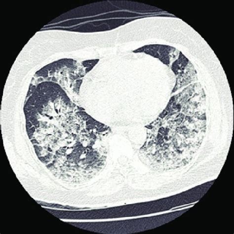 Chest Computed Tomography Showing Bilateral Diffuse Alveolar