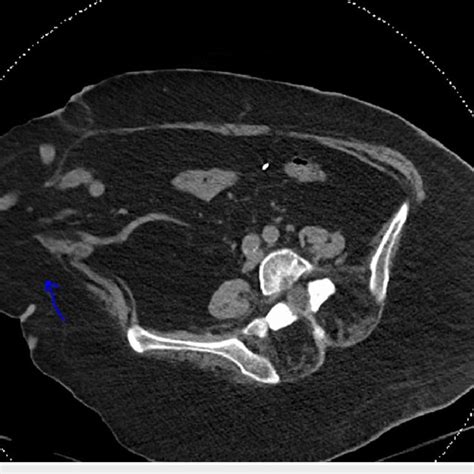 Ct Abdomen Showing Large Right Paramedian Ventral Hernia Sac That