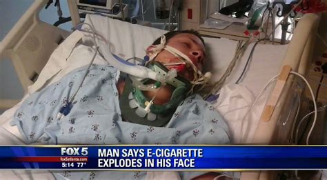 Think E Cigarettes Are Safe This Guy Did Too Until His Vape Exploded