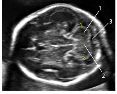 Cerebellar Vermis Fetal Ultrasound