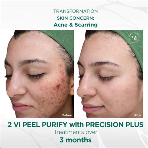 Vi Peel Purify With Precision Plus Professional Treatment Vi Derm