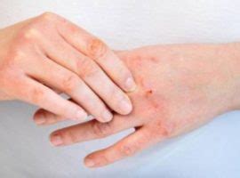 Dermatite Tipologie Cause Rimedi Naturali E Della Nonna Inversaonlus