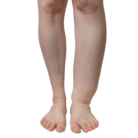 What Is Vein Disease And Lymphedema American Venous Forum