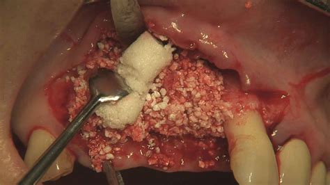 So while you're stuck at home and trying to figure out what you can do when you're feeling bored, pull up a youtube video that teaches you how to juggle. Anterior GBR procedure using Dentium regeneration ...