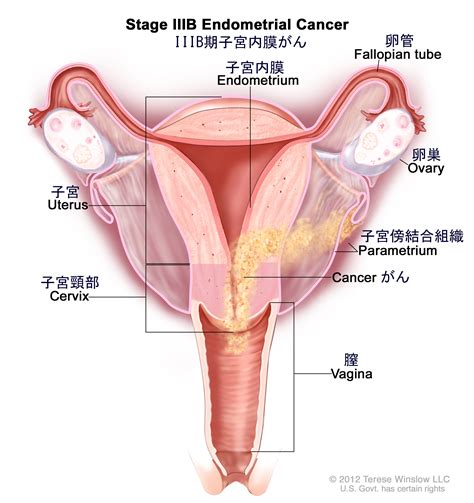 がん情報サイト がん情報各論：[患者さん向け]子宮内膜がん（子宮体がん）の治療（pdq®）