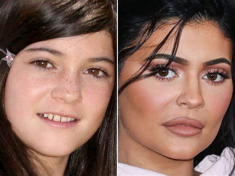 kylie jenner before and after from 2008 to 2022 the skincare edit