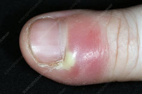 Paronychia Infection Of The Thumb Stock Image C0111661 Science
