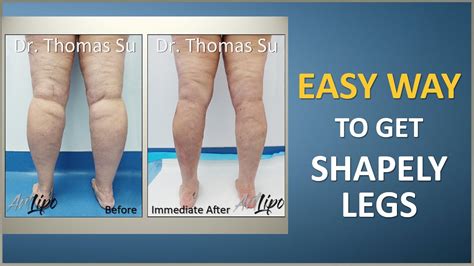 Lipo 360° Legs Cankles And Knees Liposuction Results Lipedema Surgery Expert Dr Thomas Su