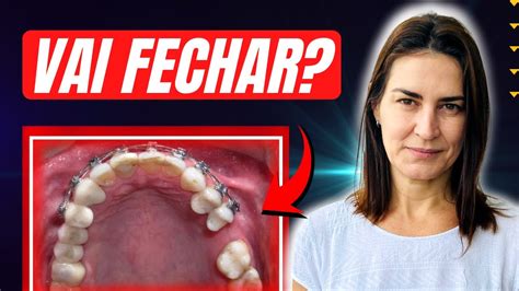 DÁ Pra Fechar EspaÇo De Dente Perdido Usando Aparelho OrtodÔntico Dentista Responde Youtube