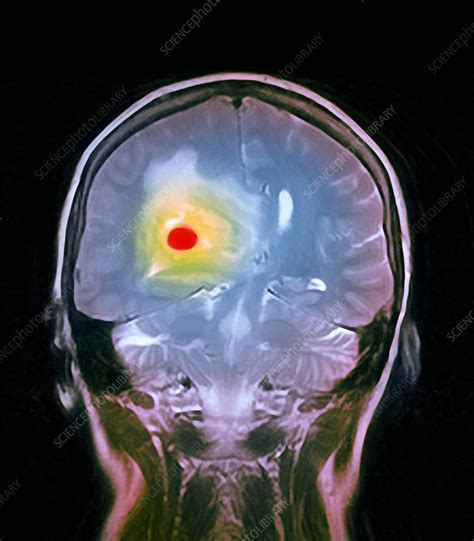 Brain Tumour Mri Scan Stock Image M1340869 Science Photo Library