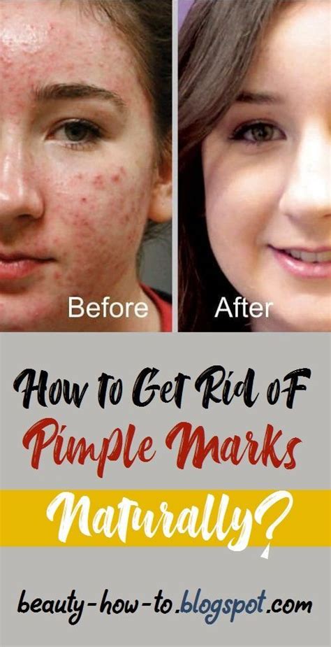 How To Get Rid Of Pimple Marks Naturally Pimple Marks How To Remove