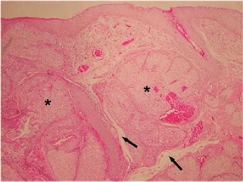 Sebaceous Gland Hyperplasia The Lesion Is Composed By Hyperplastic