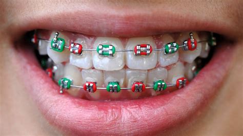 Braces Colors Your Guide To Picking The Best Color For Your Teeth