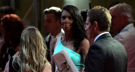 What Happened To Turia Pitt Post Birth She Writes A Strong Message With A Fit Body